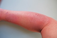 David and the joys of poison ivy