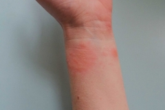 Aimee and the joys of poison ivy